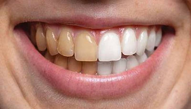 علل اصلی زرد شدن دندان‌ها